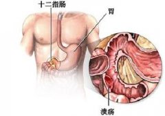 胃十二指肠溃疡